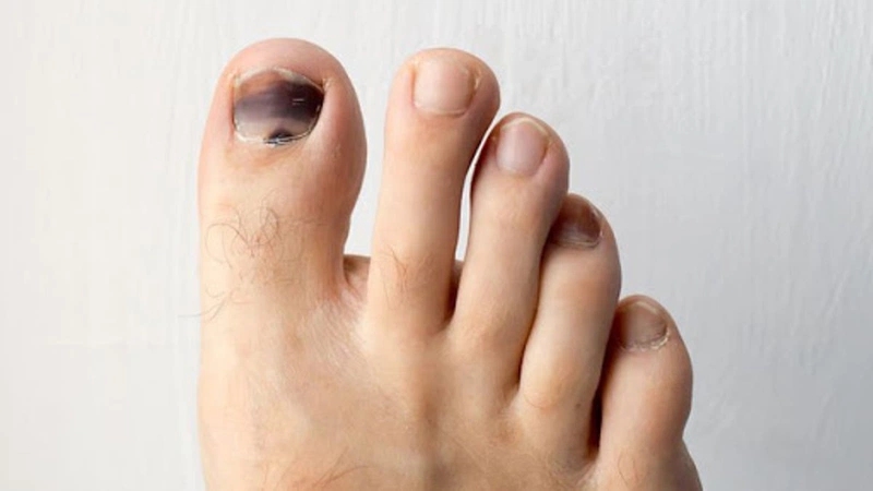 Móng chân đen có phải là dấu hiệu của bệnh nghiêm trọng?